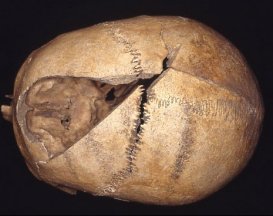 Unhealed cut in skull Unhealed cut in skull