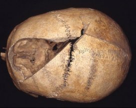 Unhealed cut in skull