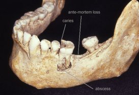 Dental disease