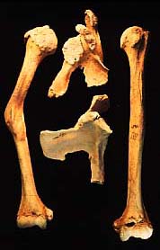 Fractured humerus with dislocation